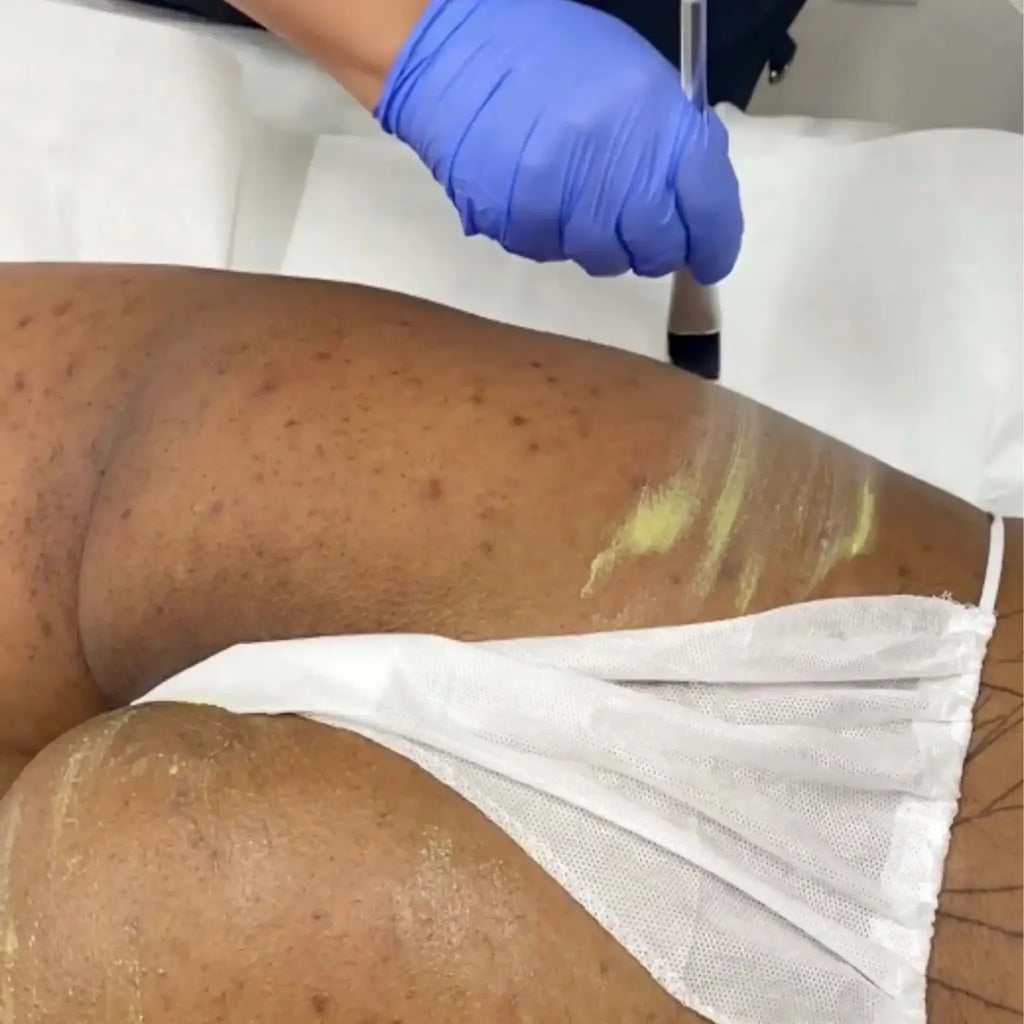 BootyFix: DSE Peel + Microneedling – Beauty Fix MedSpa