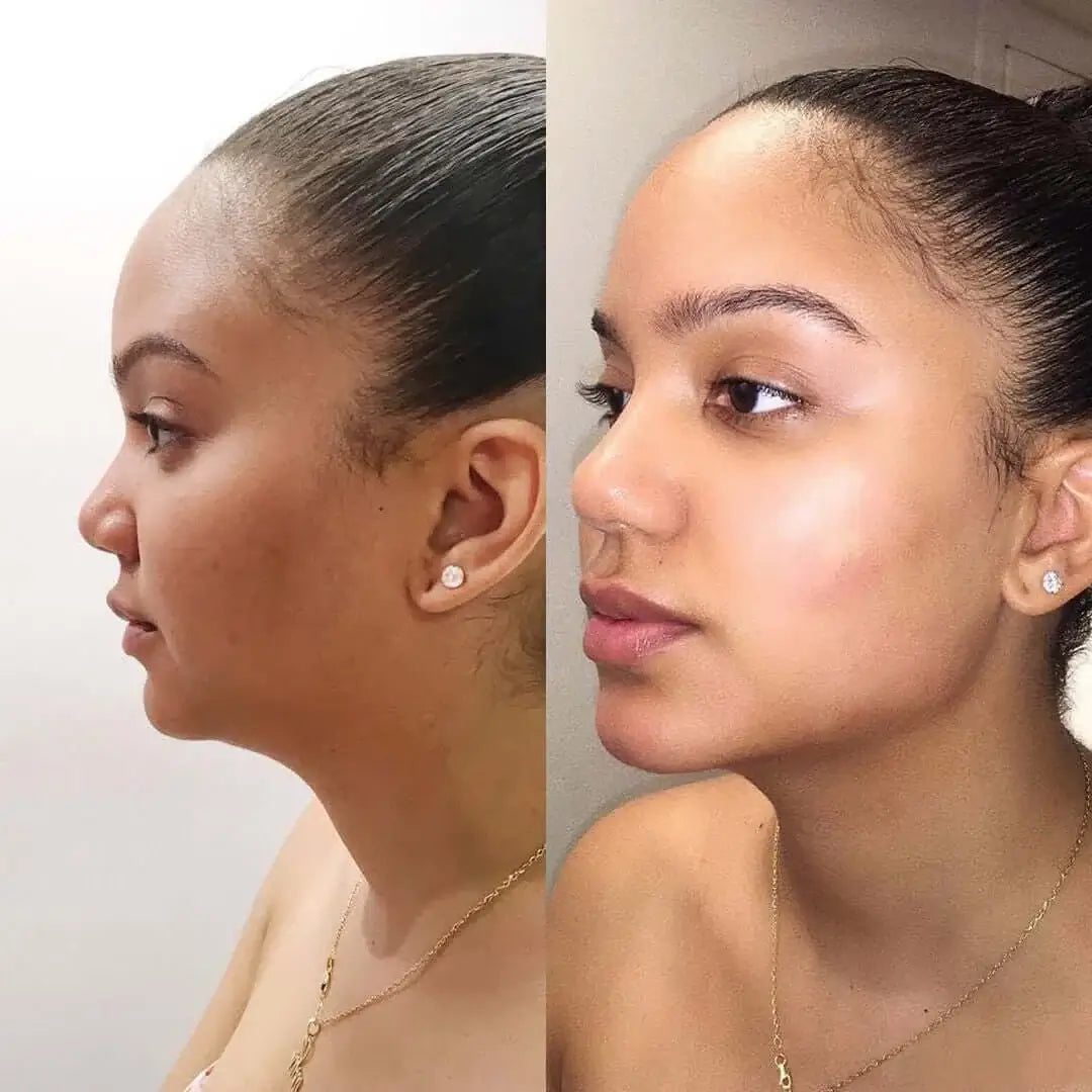 CheekFix: Filler – Beauty Fix MedSpa