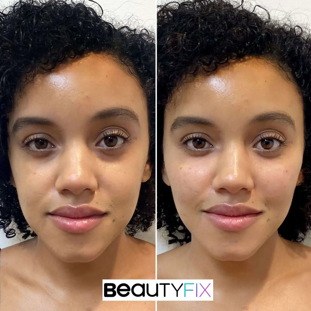 CheekFix: Filler – Beauty Fix MedSpa