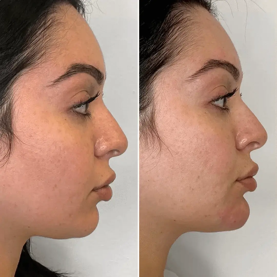 美容皮膚医学BEAUTY #13(Vol.2 No.12 ChinFix: Filler | BeautyFix MedSpa - (212) 366-4787