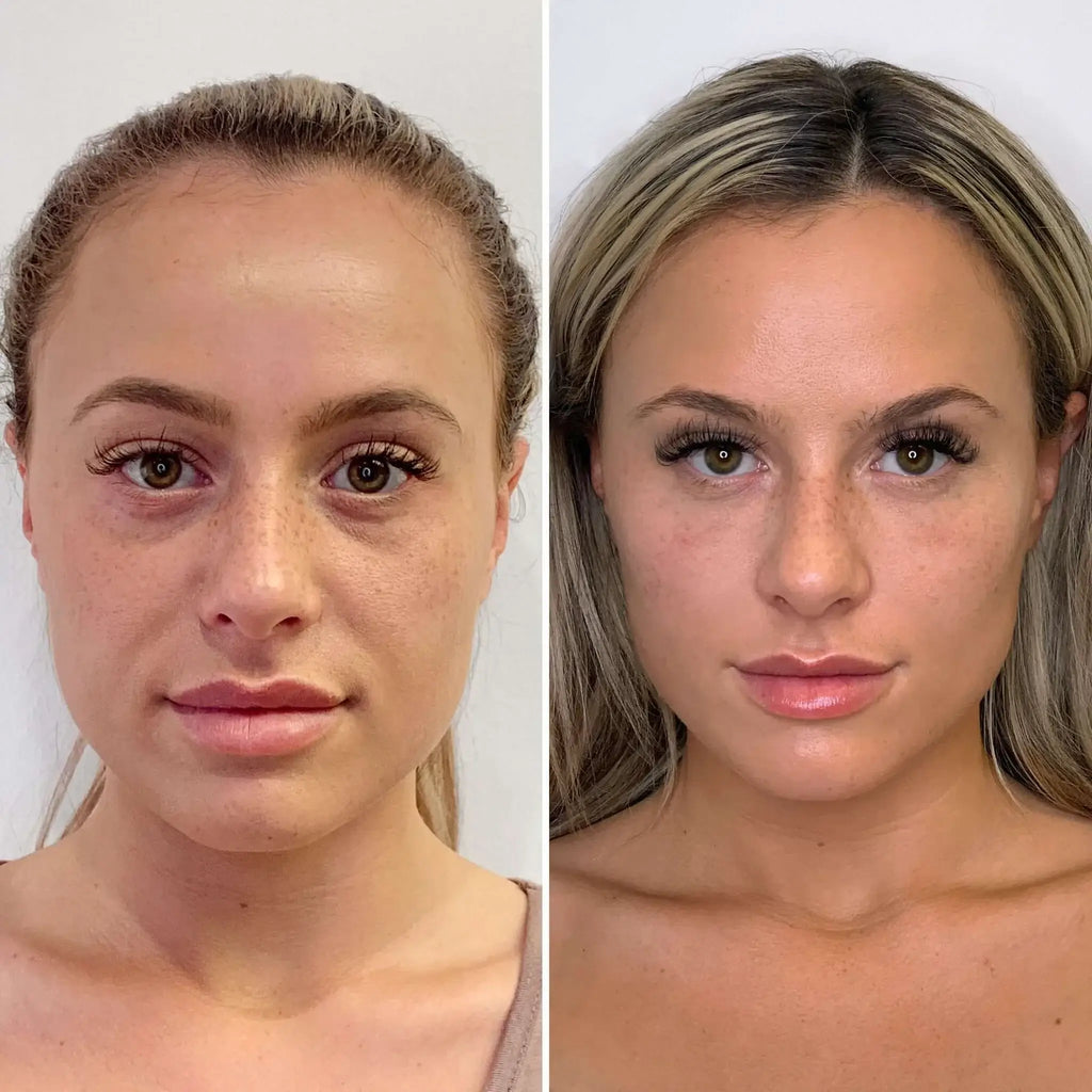 EyeFix: Filler – Beauty Fix MedSpa