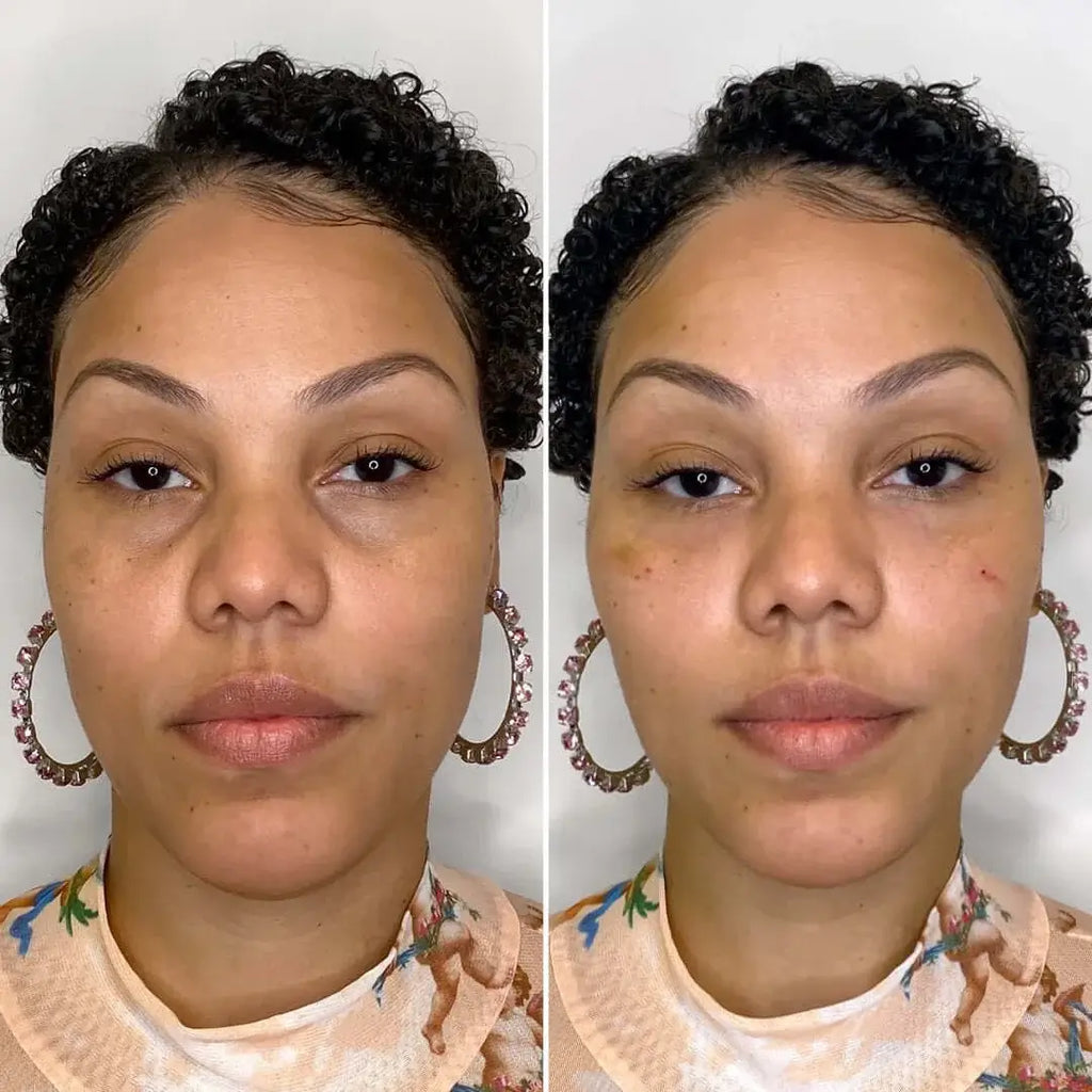 EyeFix: Filler – Beauty Fix MedSpa