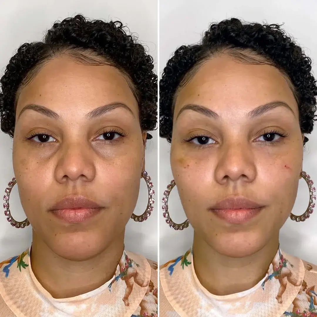 EyeFix: Filler – Beauty Fix MedSpa