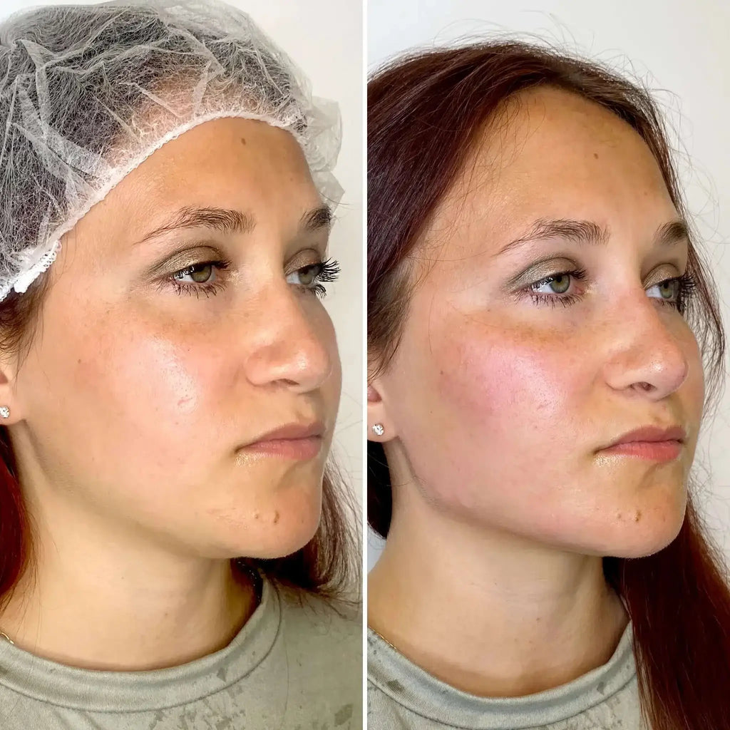 JawlineFix: Filler – Beauty Fix MedSpa