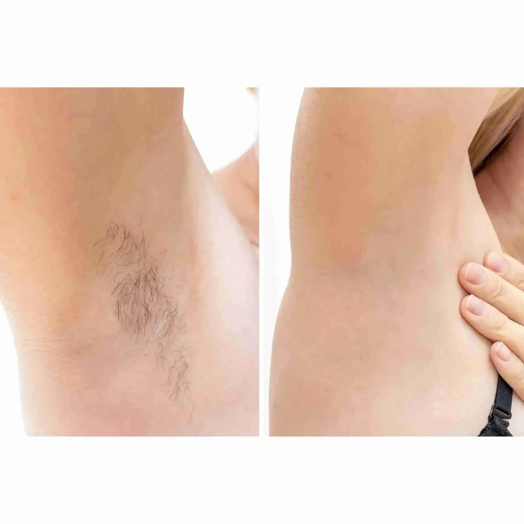 HairFix: Laser Hair Removal Medium – Beauty Fix MedSpa