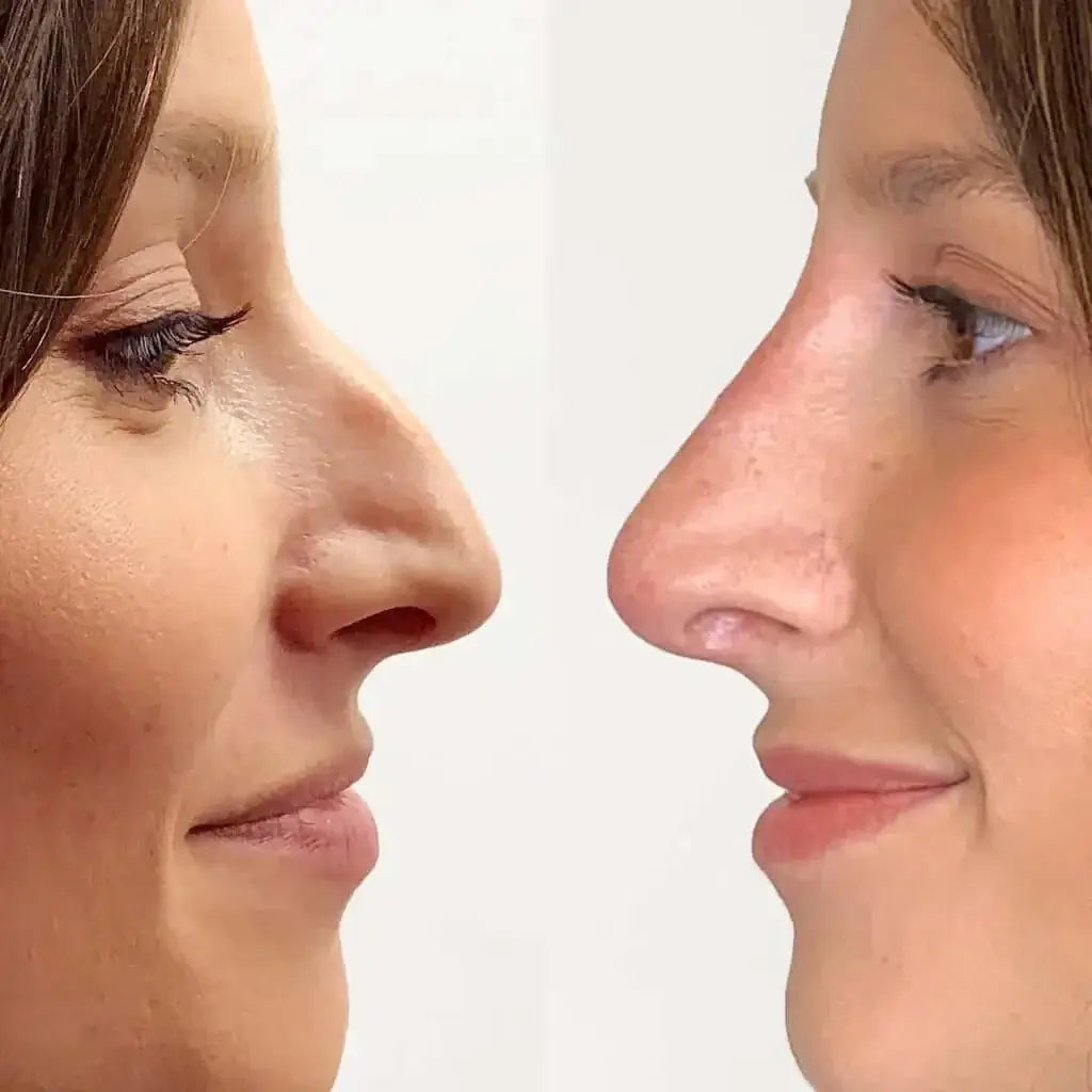 NoseFix: Filler – Beauty Fix MedSpa