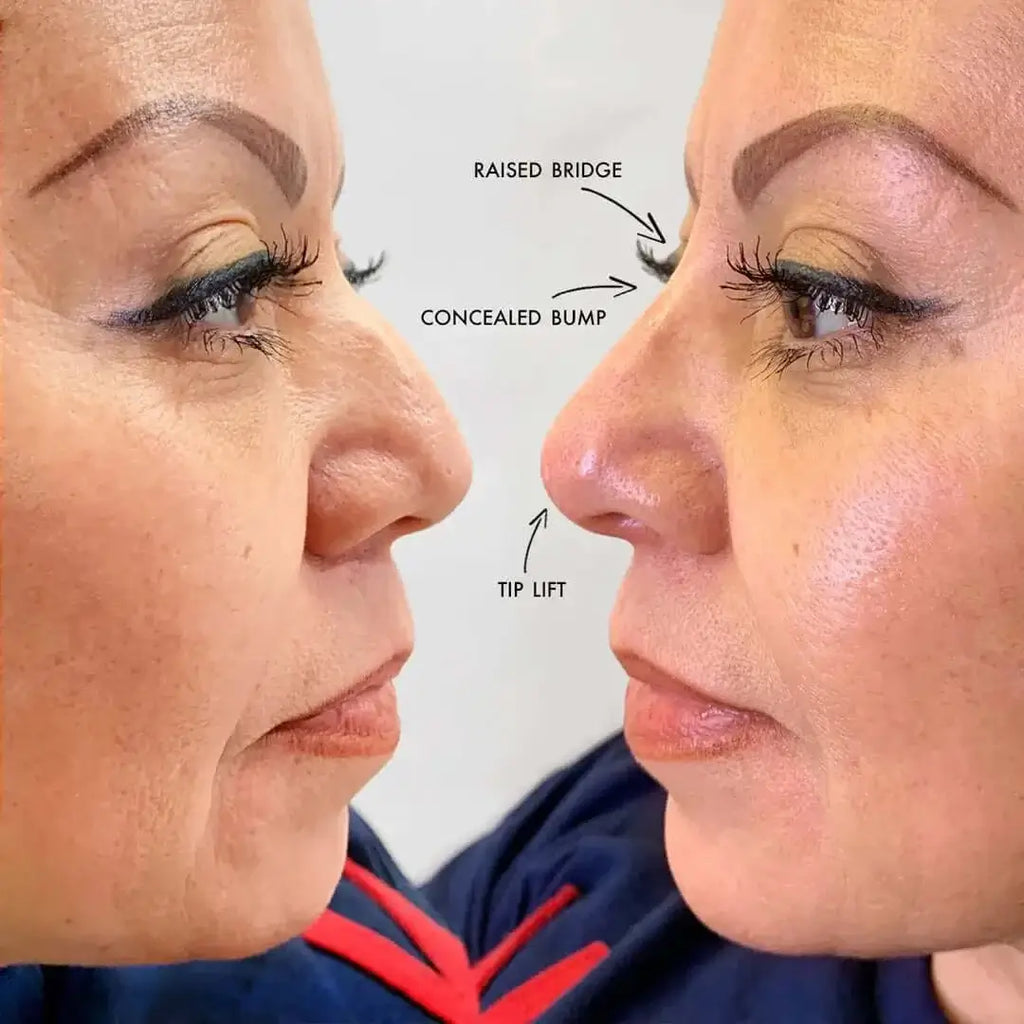 NoseFix: Filler – Beauty Fix MedSpa