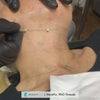 NeckFix: Thread Lift – Beauty Fix MedSpa