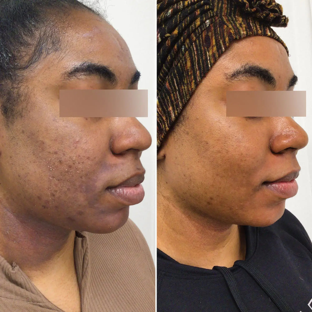 SkinFix: VI Peel – Beauty Fix MedSpa