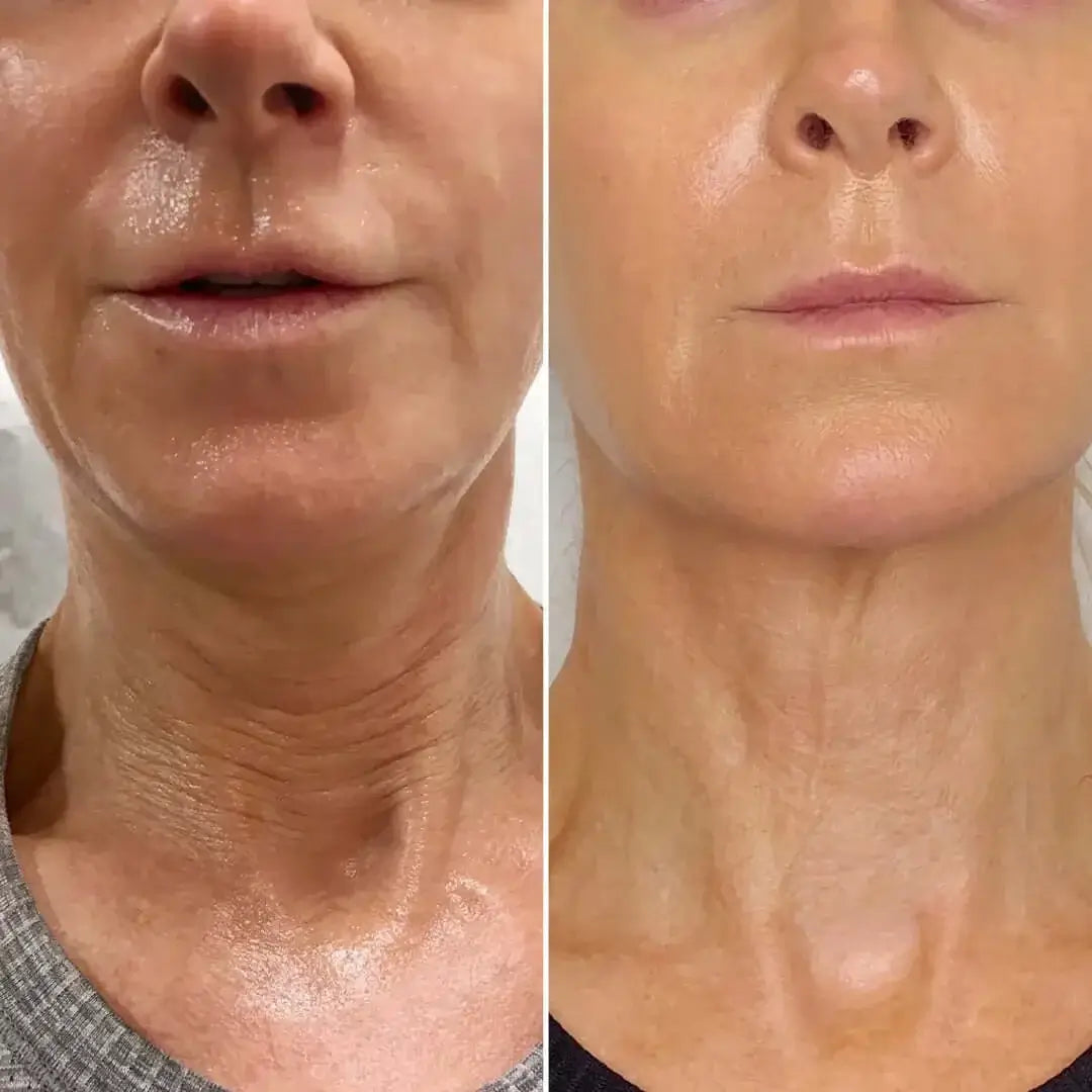 NeckFix: Filler – Beauty Fix MedSpa