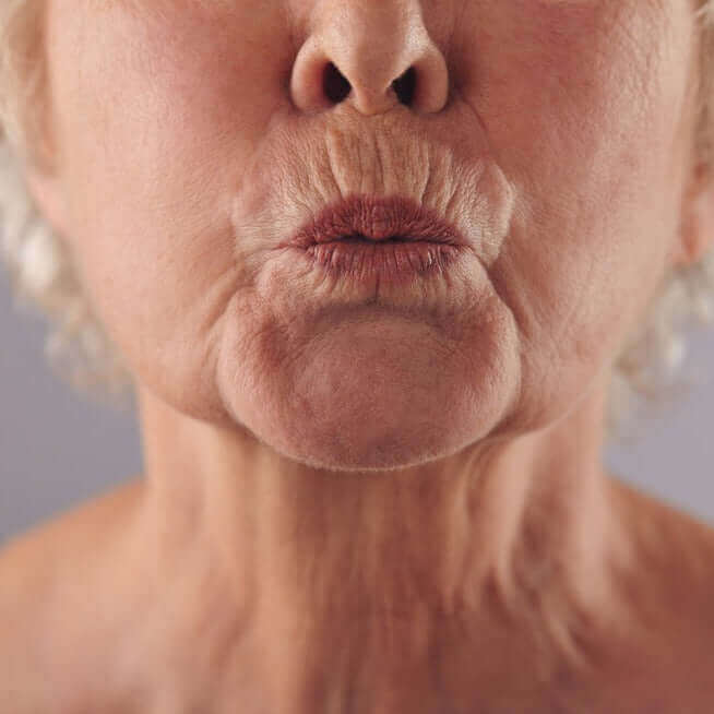 WrinkleFix: Smoker's Lines – Beauty Fix MedSpa