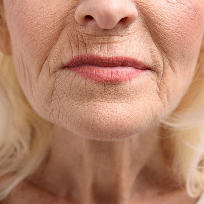 WrinkleFix: Smoker's Lines – Beauty Fix MedSpa