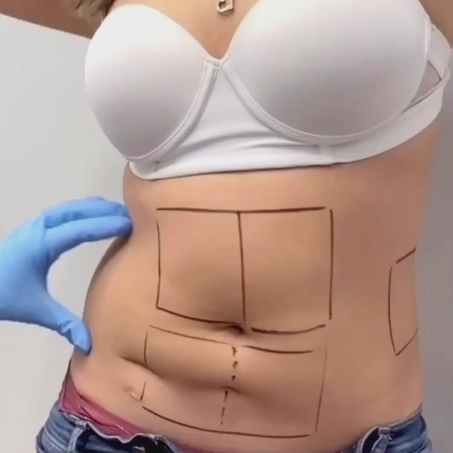AbFix_truSculptiD_Video1