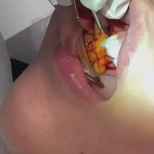 FaceFix_BuccalFatRemoval_Video1