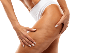 Av&eacute;li&trade; Cellulite Treatment