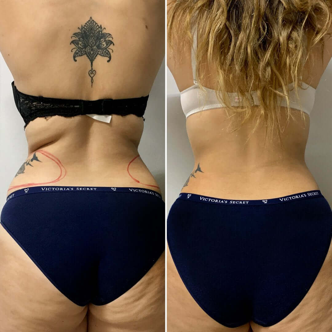 AbFix CoolSculpting before and after