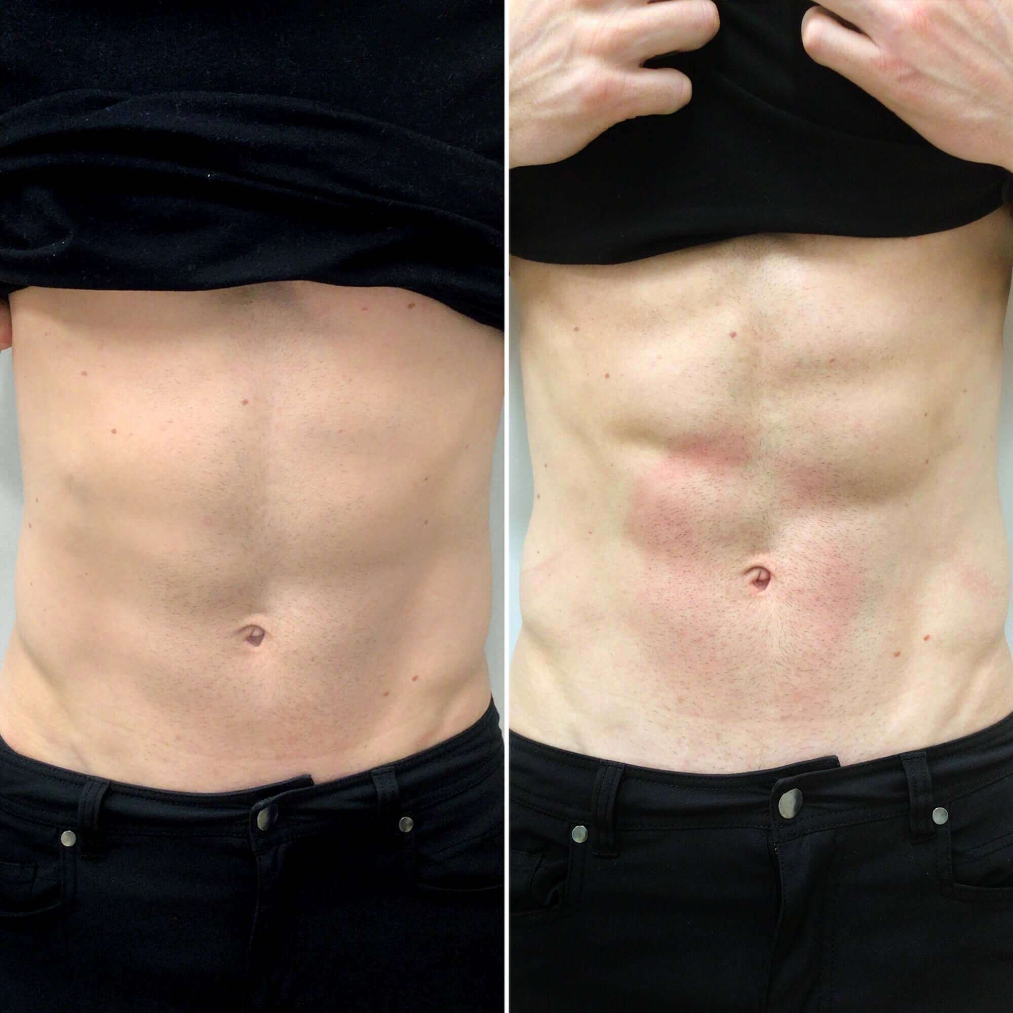 AbFix EmSculpt NEO before and after