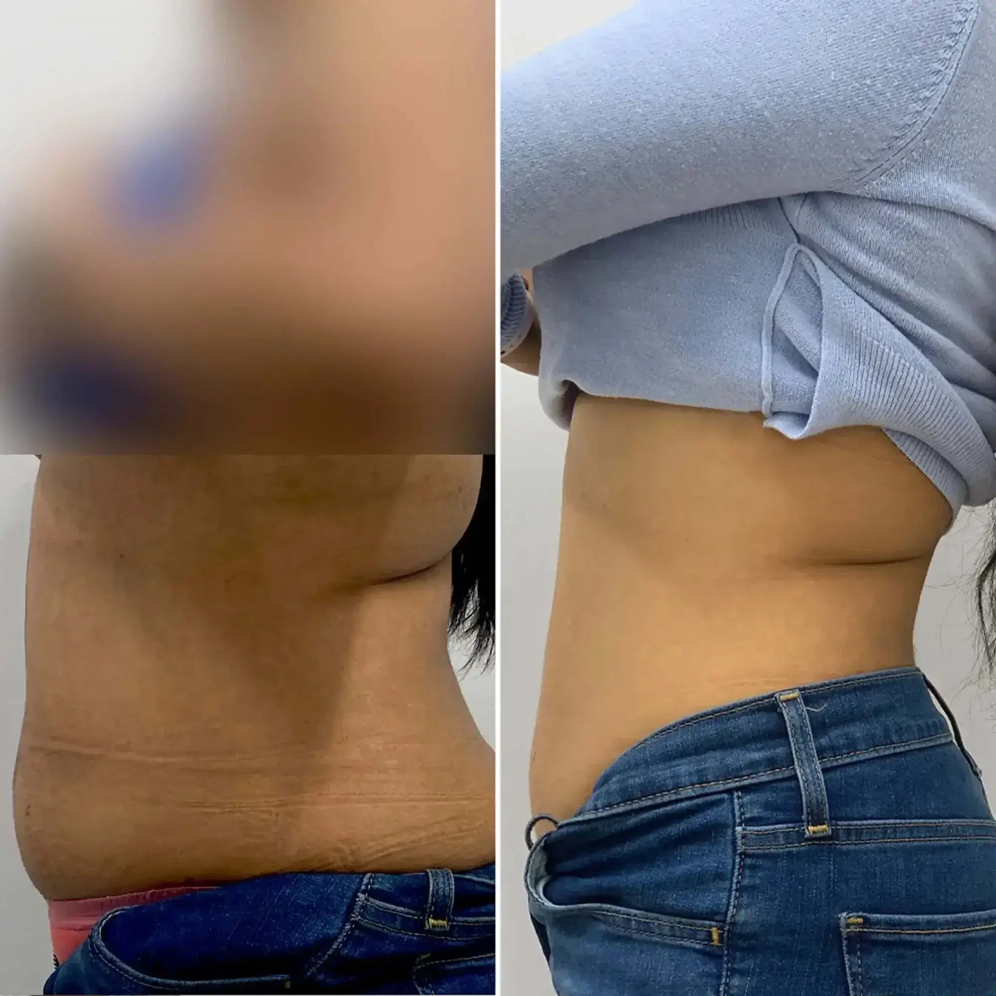 AbFix EmSculpt NEO before and after
