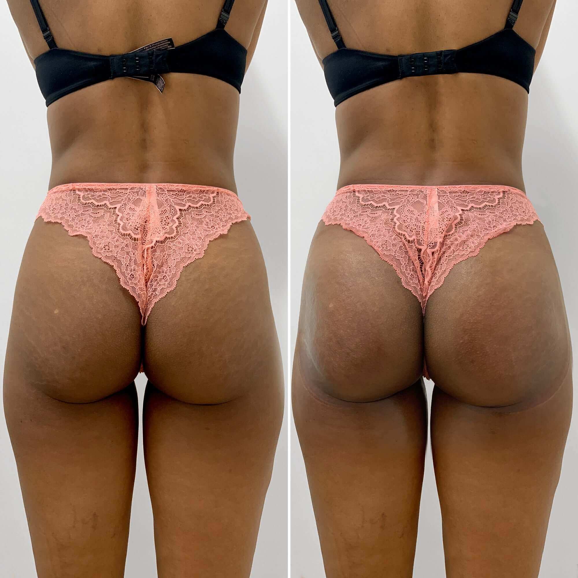 BootyFix ButtVac before and after