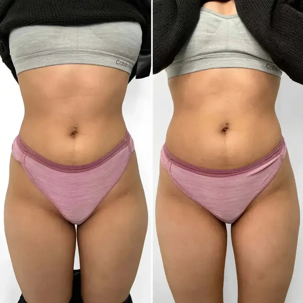 BootyFix Sculptra before and after