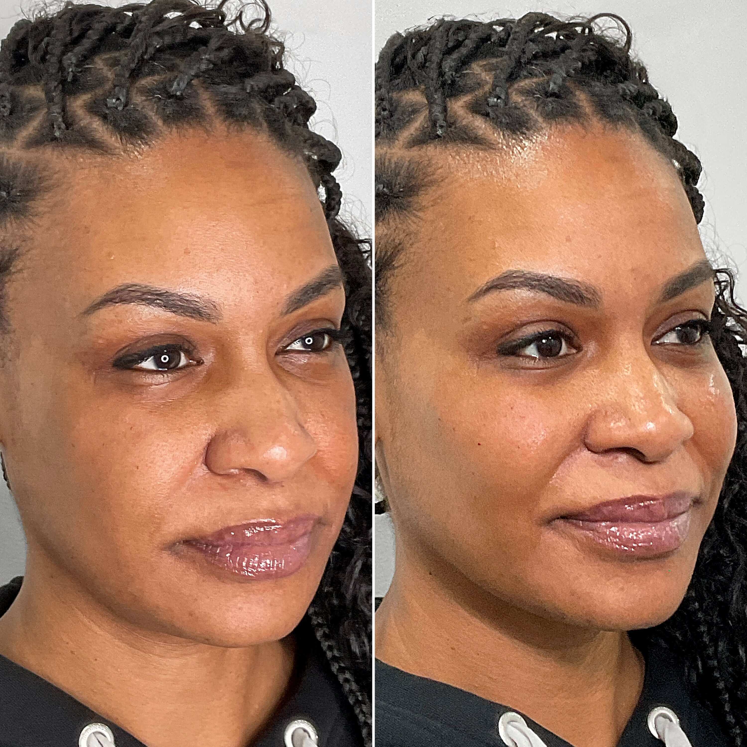 CheekFix ChinFix filler before and after