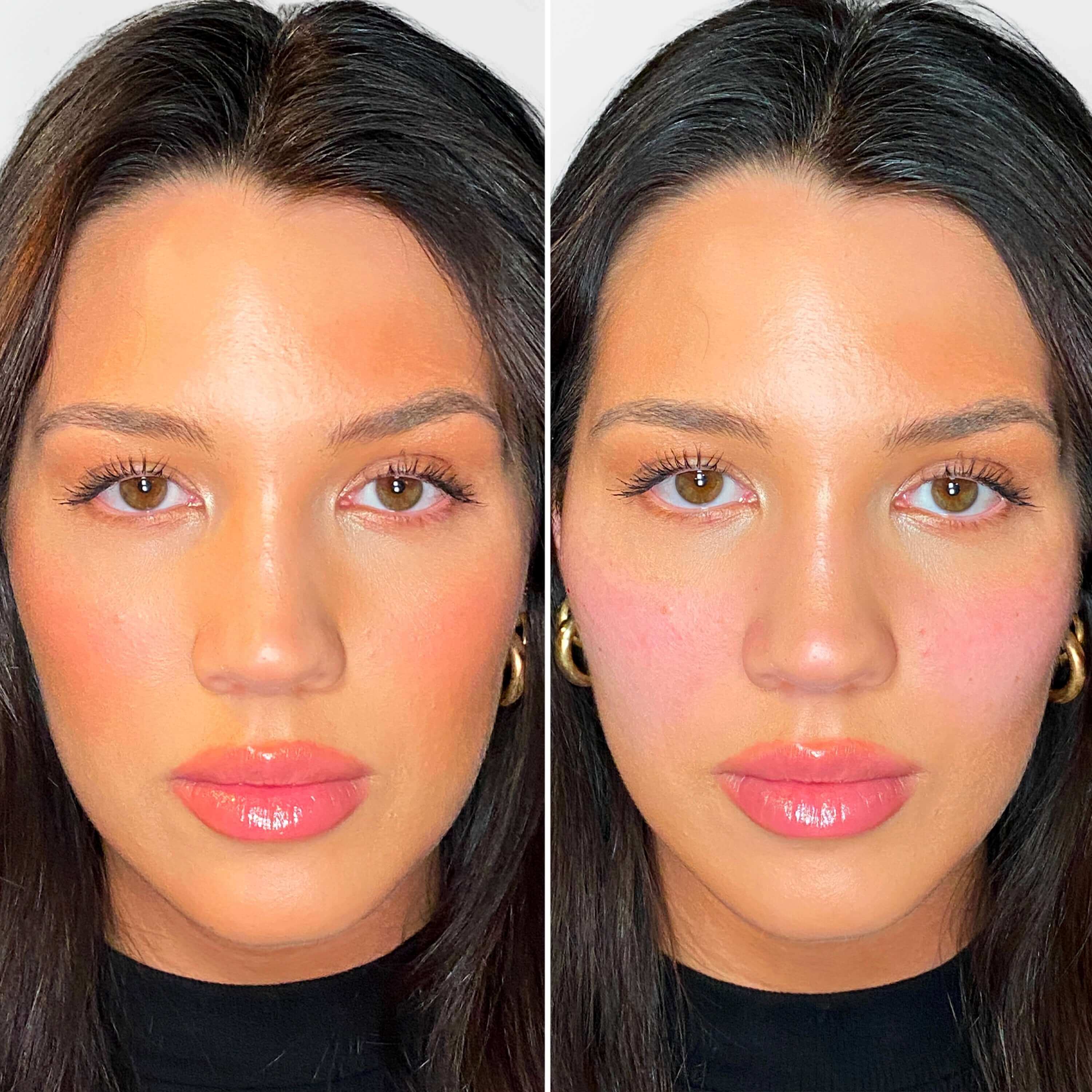 CheekFix filler before and after