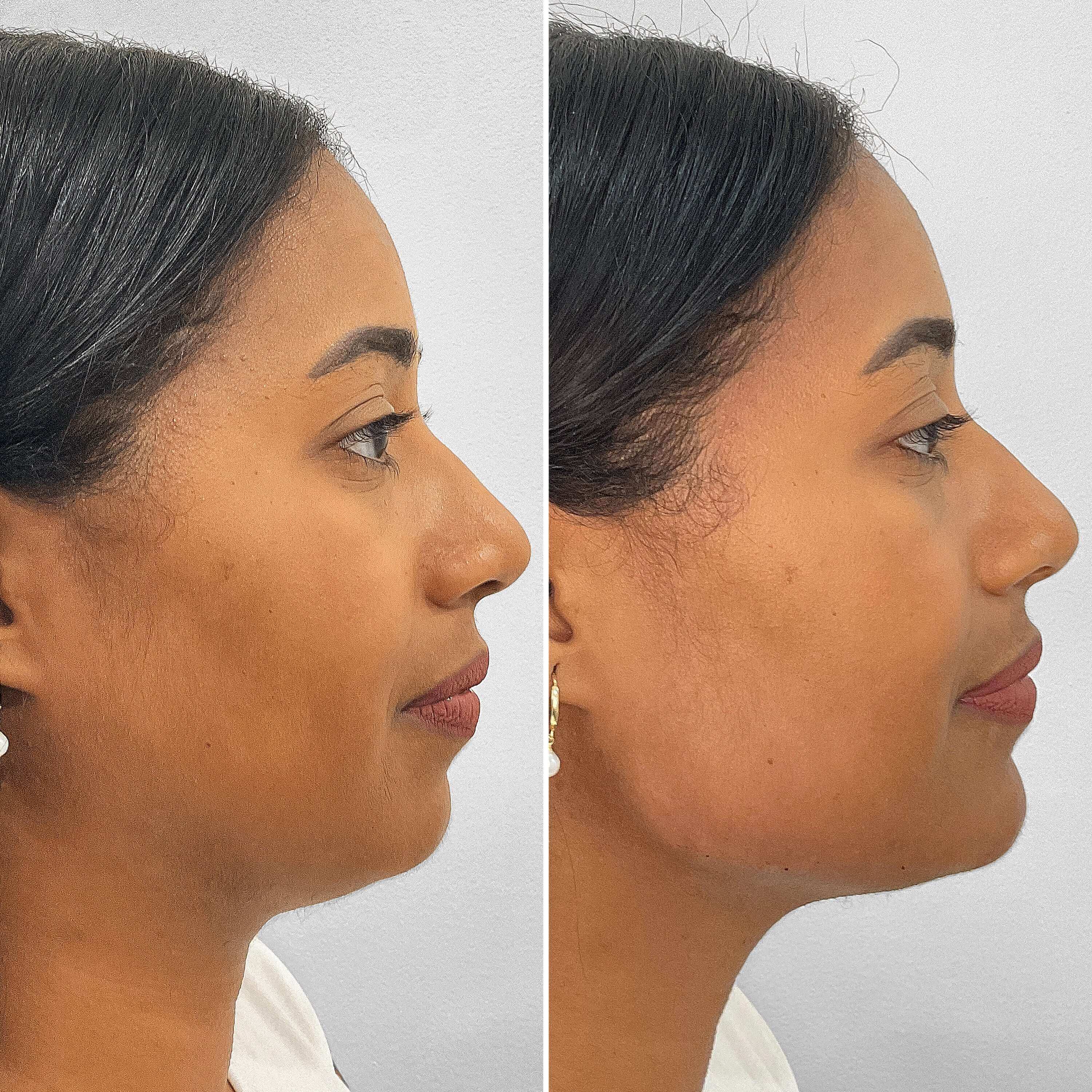 ChinFix JawlineFix filler before and after