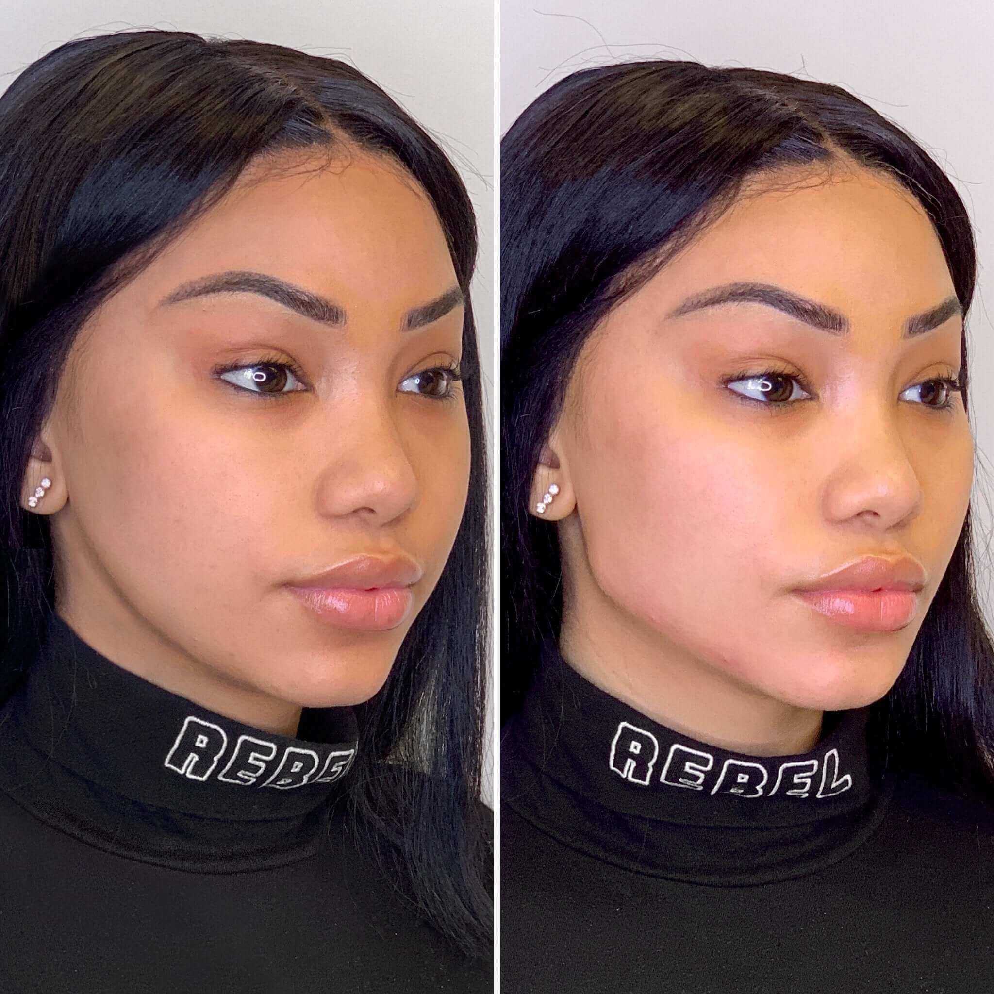 JawlineFix filler before and after