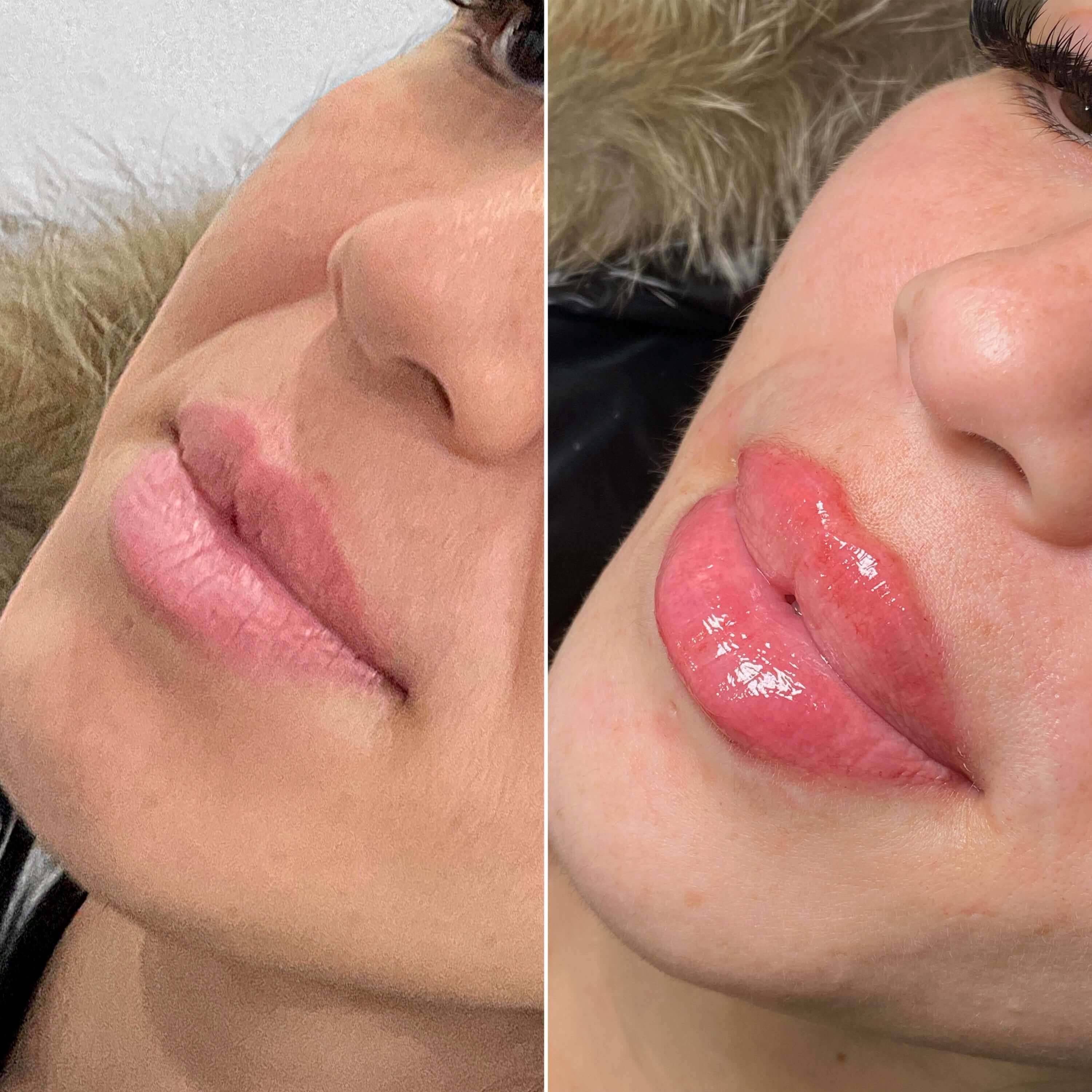 LipFix filler before and after