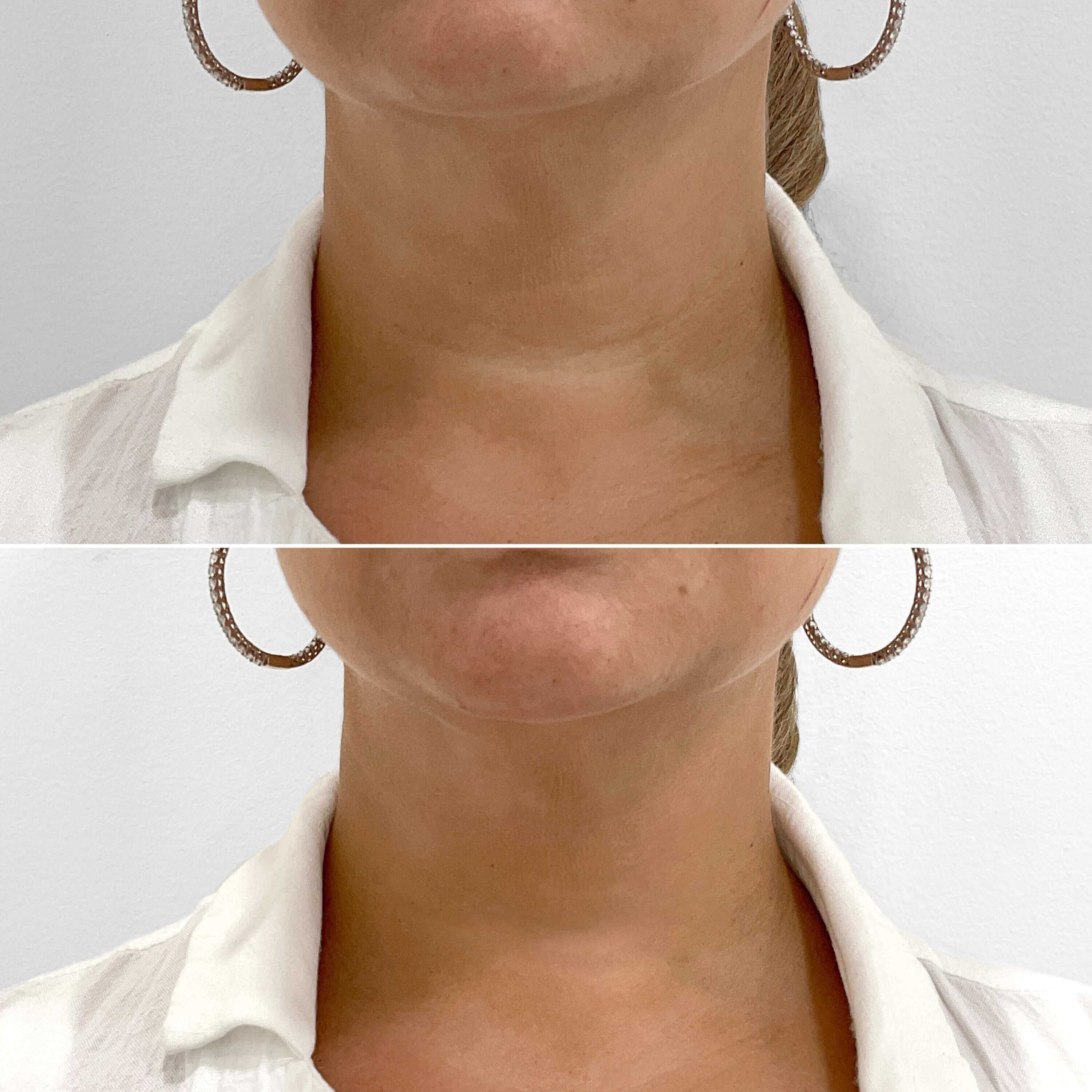NeckFix filler before and after