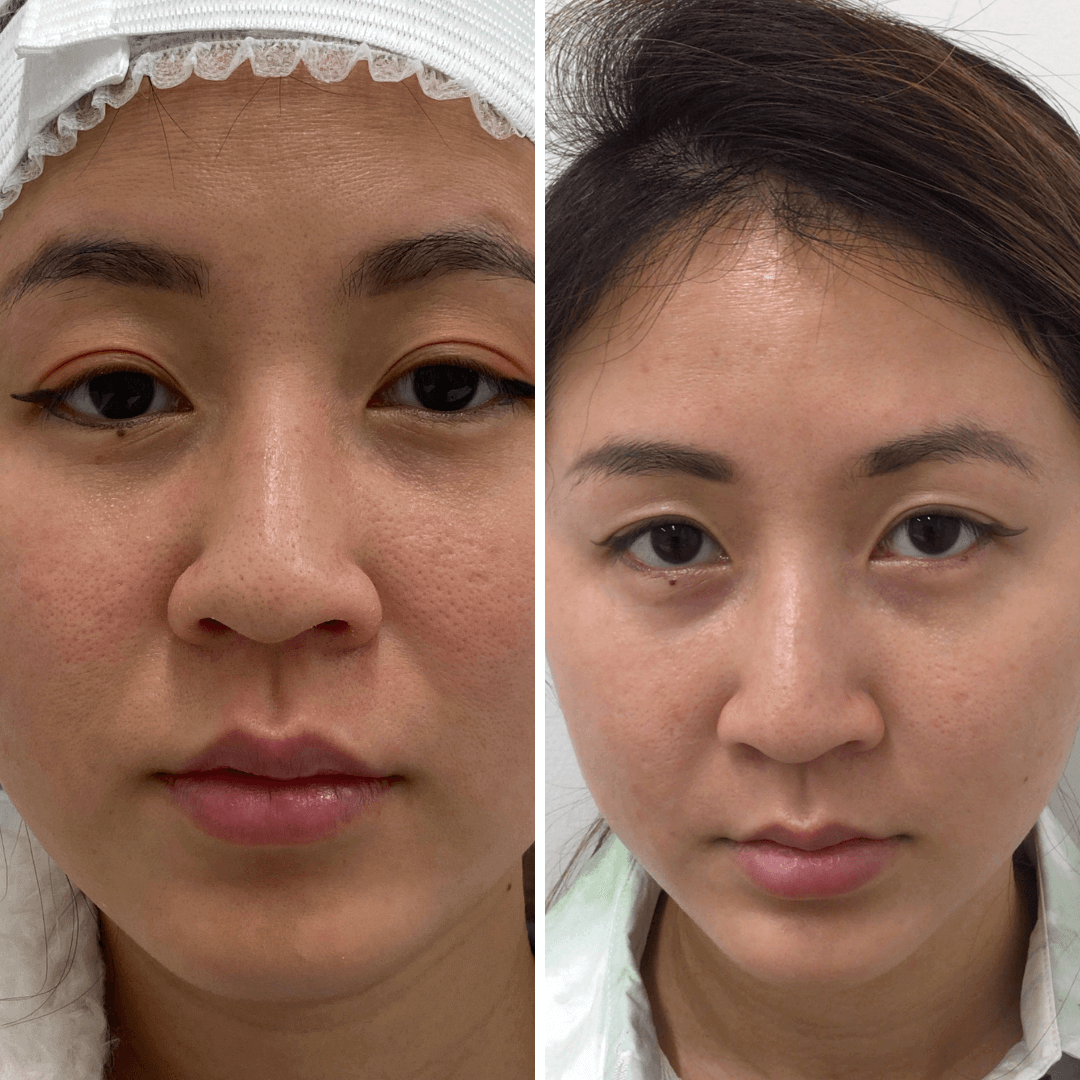 SkinFix Laser Genesis before and after