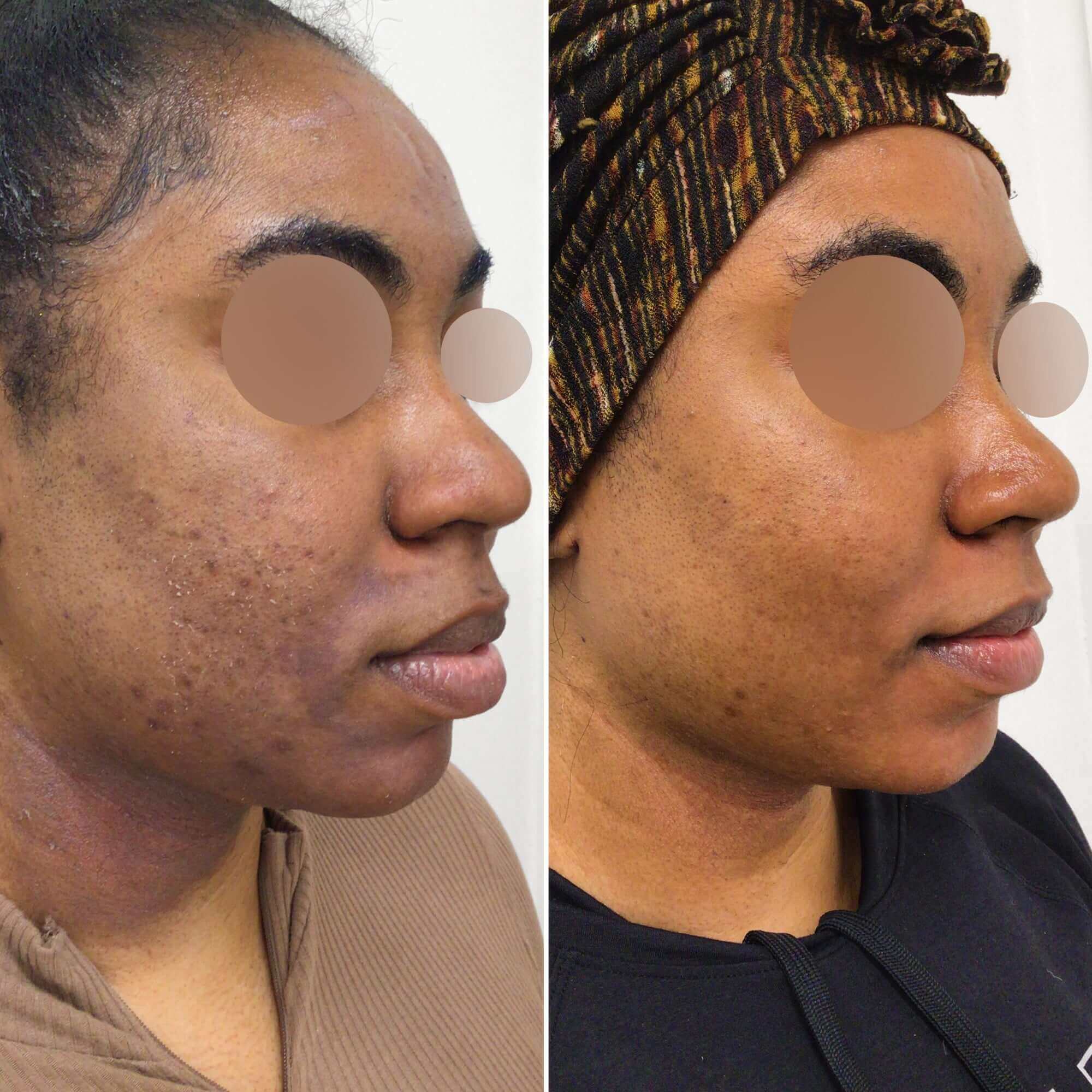 SkinFix VI Peel before and after