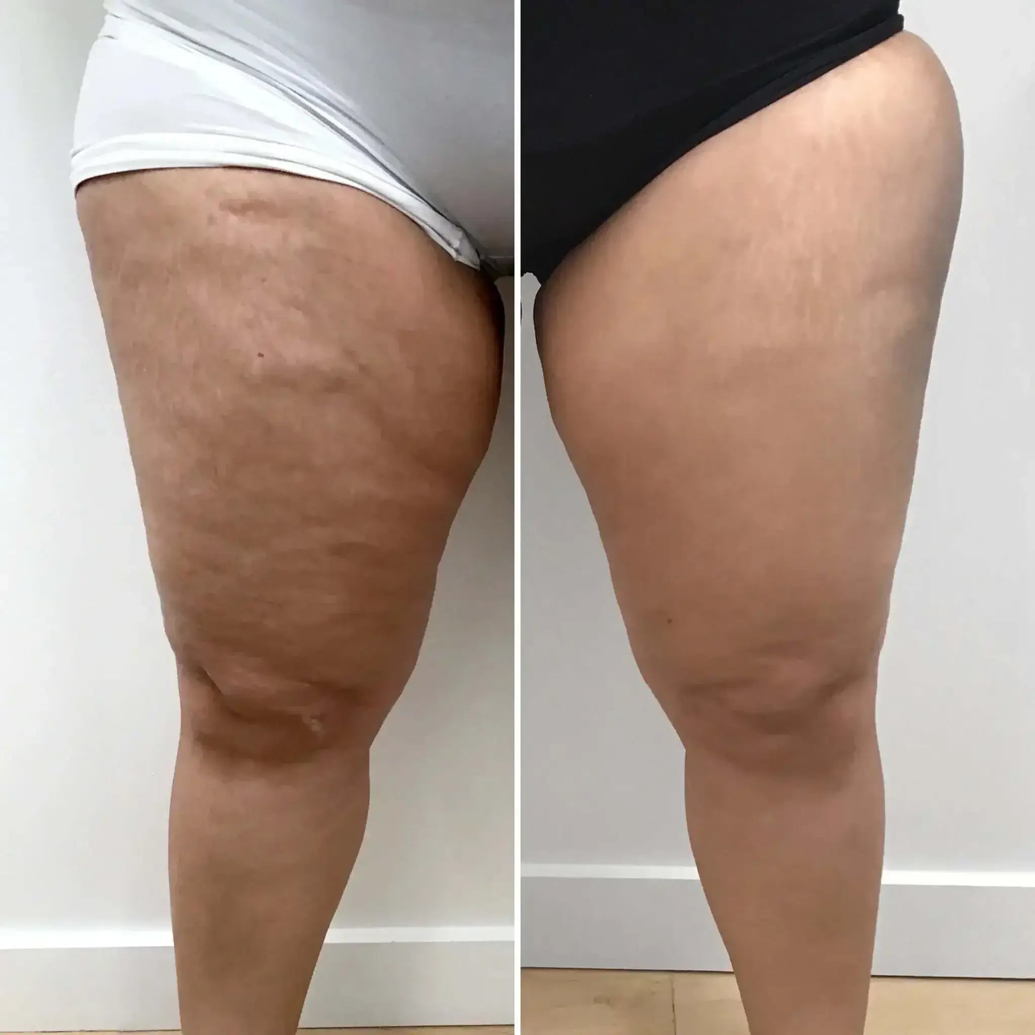 ThighFix CelluliteFix Venus before and after