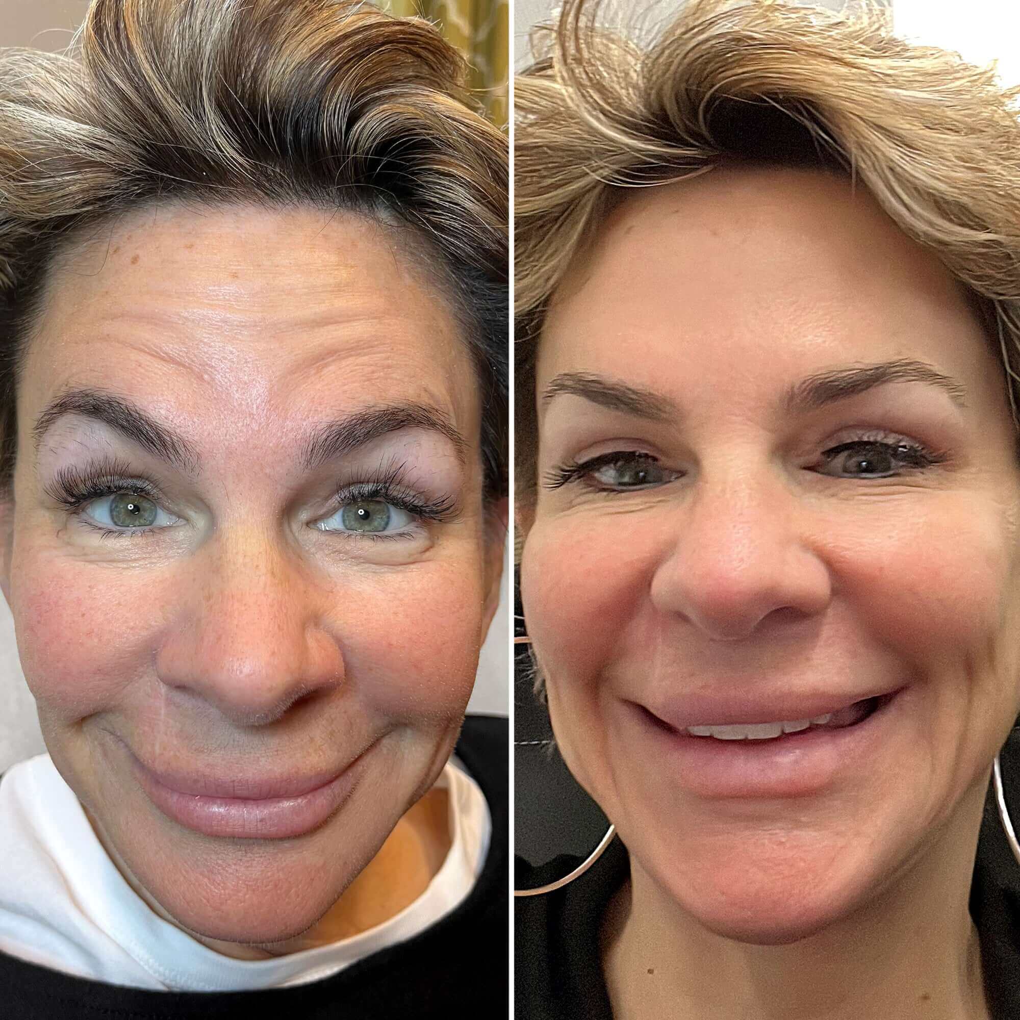 WrinkleFix Daxxify before and after