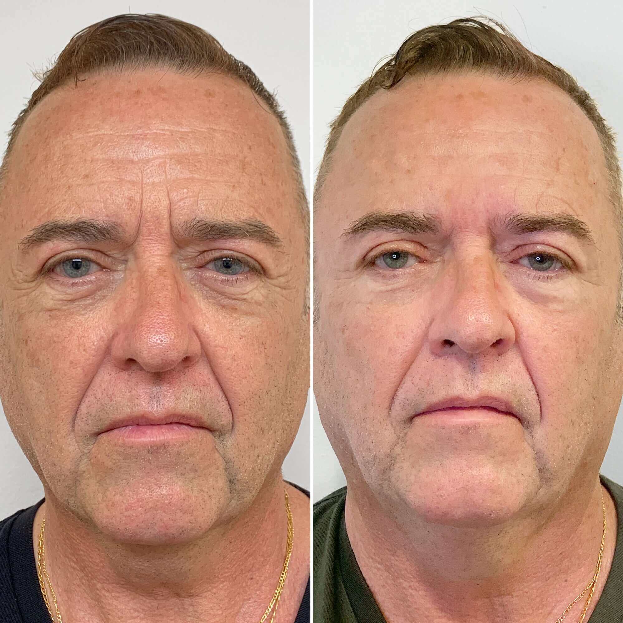WrinkleFix glabellar lines before and after