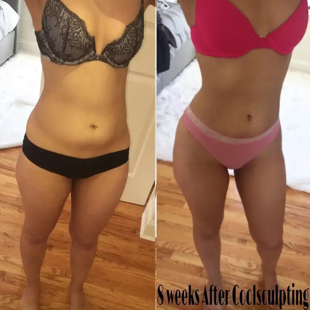 CoolSculpting before and after