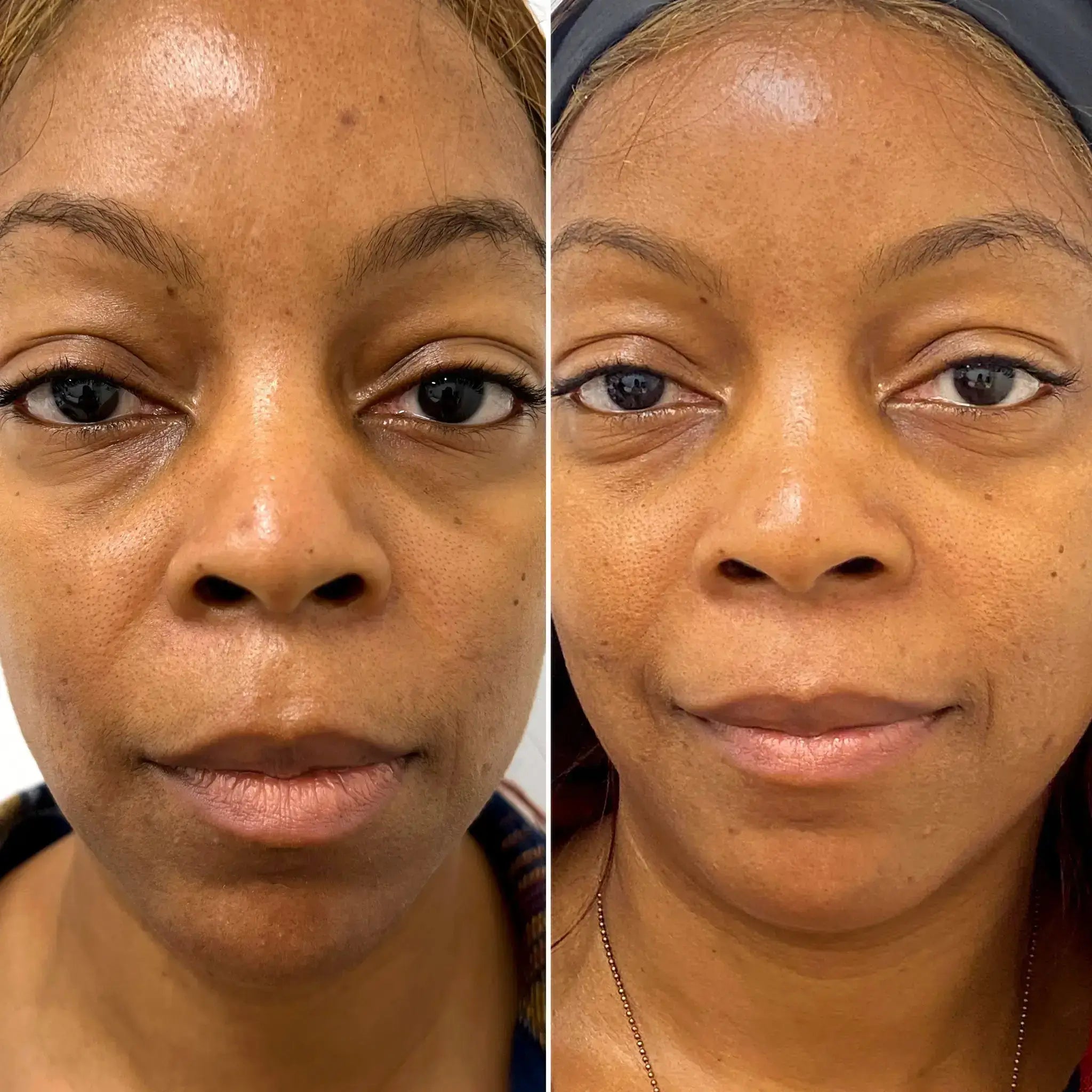 SkinFix VI Peel before and after