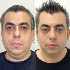 Chin Liposuction_beautyFix Plastic Surgery