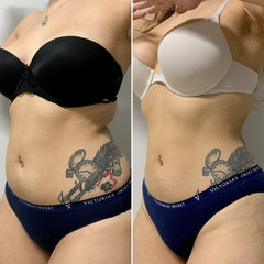 AbFix CoolSculpting_BeautyFix