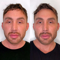 Jawline_CheekFix_BeautyFix
