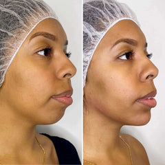 Jawline_Chin Filler_BeautyFix