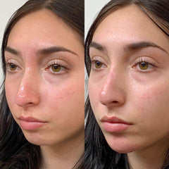 Nose_Chin_Cheek Filler_BeautyFix