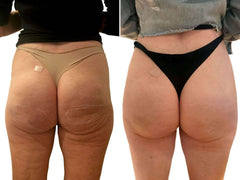 Sculptra Butt Lift And Fillers_BeautyFix