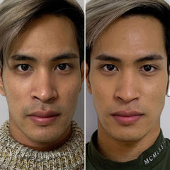 SkinFix: FractionalRF BeautyFix