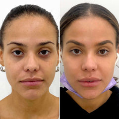 Eye_CheekFix_BeautyFix